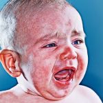 A-Baby-with-eczema-150x150